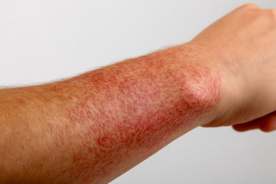 Inflamed and irritated skin rash covering the forearm with red patches indicating allergic reaction or dermatitis on a person?s arm against a neutral background