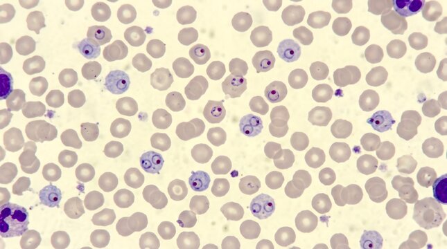 Malaria Plasmodium Falciparum Blood Smear