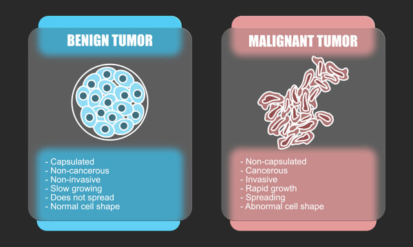 Vector illustration of malignant and benign tumors in body tissues. Difference between malignant and benign tumors, Spread of cancer cells. Glass effect design for education, posters, clinics,