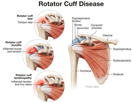 Rotator Cuff Disease . Medical Illustration of Tear, Bursitis, and Tendinopathy. Labeled