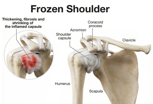 Frozen Shoulder. Medical Illustration Showing Inflammation and Fibrosis of the Shoulder Capsule. Labeled