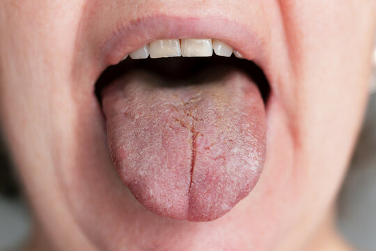Caucasian woman suffering from glossitis, a tongue disease.