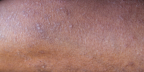 Fototapeta premium Men skin texture that looks dry, cracked, and scaly.