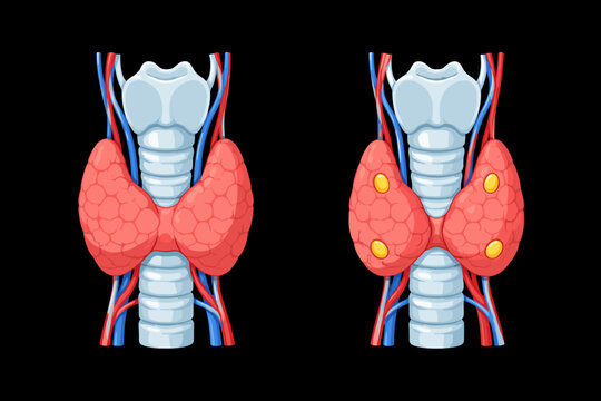 Anatomical vector illustration of the human thyroid gland and trachea. Comparison of the thyroid with and without parathyroid glands. Medical diagram for endocrine system education and health.