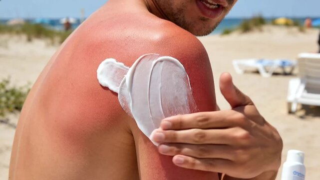 Man applying soothing cream on sunburned shoulder at beach, skin care and sun protection treatment for summer health and UV damage relief