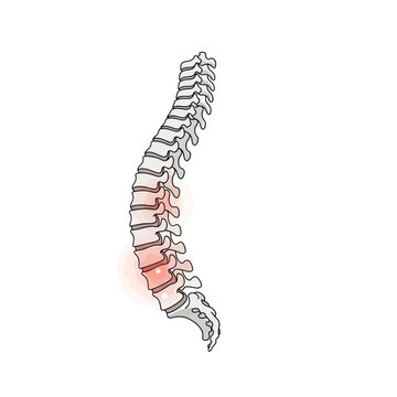 Medical vector illustration of the human vertebral column showing inflammation in the lumbar spine area, representing ankylosing spondylitis, chronic back pain, or spinal arthritis.