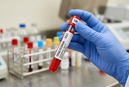 Gloved hand holding a triglyceride blood test tube