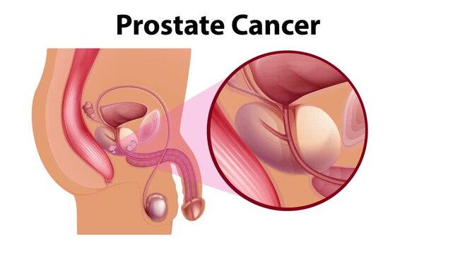 Prostate cancer medical diagram showing enlarged prostate with malignant tumors and male reproductive system anatomy motion graphics.