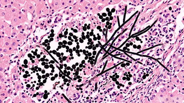 GMS Stain Histopathology of Candida Albicans Budding Yeast and Filaments in Tissue
