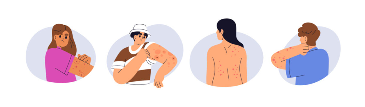 Rash, inflammation, irritation and redness on skin. Itch, allergy, red marks from insect bites. Dermatology problems, alergic reaction on body. Flat vector illustration isolated on white background