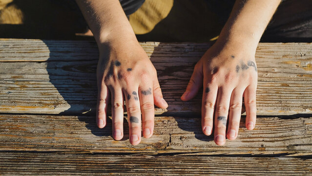 Hands with vitiligo on wooden surface showing skin depigmentation and natural texture closeup