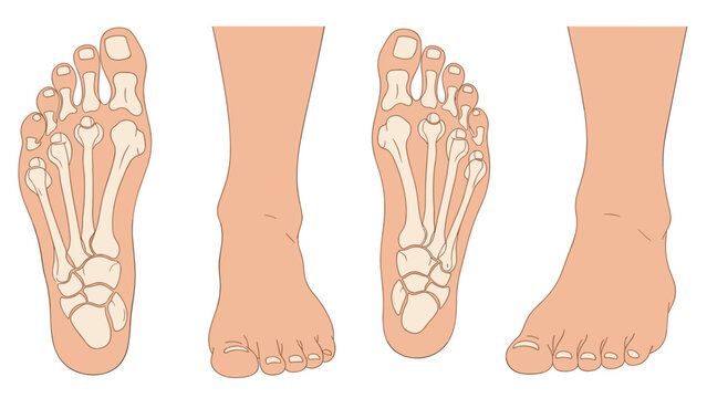 Anatomical illustration showing the bone structure and surface anatomy of the human foot from multiple angles including top and side views.