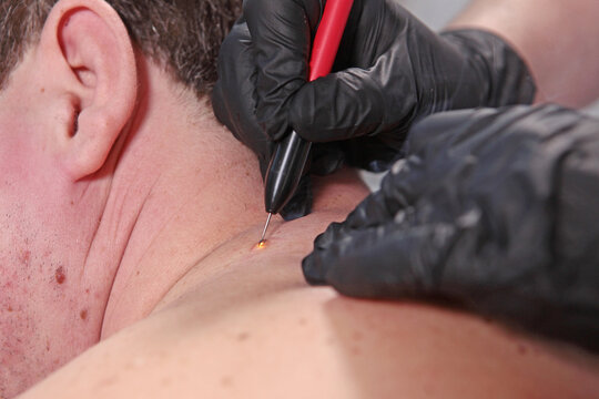 Man undergoing procedure to remove warts and papillomas. Aesthetic medicine. Laser removal of papillomas on skin. Prevention of melanoma. Laser cauterization of benign growths on skin.