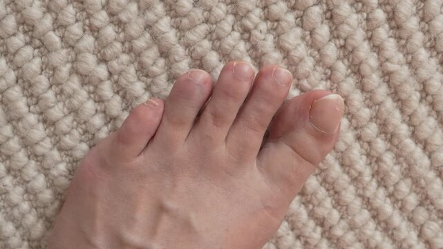 Close-up of foot with swollen and bruised toe. Medical condition, injury and pain concept.