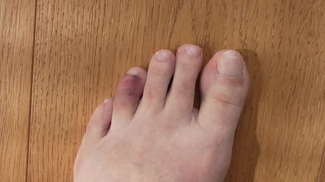 Foot with visible toe trauma on wooden surface. Healthcare, pain and recovery theme.