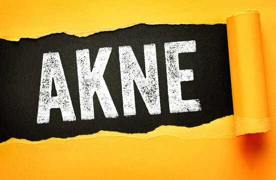 Akne text appearing behind torn paper. Medical concept about skin conditions, pimples, dermatology, skincare problems, and facial health issues