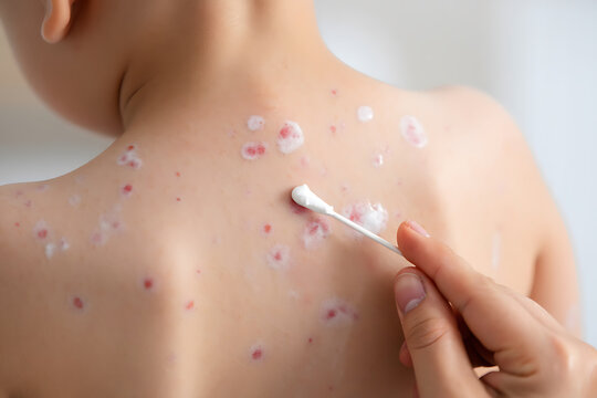 Child's back with red spots and white lotion being applied by cotton swab skin rash