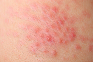 Fototapeta premium Close up of human skin with red bumps and irritation texture