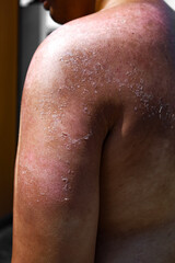 Naklejka premium Close-up Macro Sunburned and Peeling Skin Back and Arm Upper Body