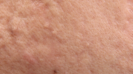 Fototapeta premium Blackheads acne. Macro close up image of facial skin and nose. showing visible pores blackheads acne marks and skin texture. Ideal for skincare dermatology cosmetic treatment and skin health concepts