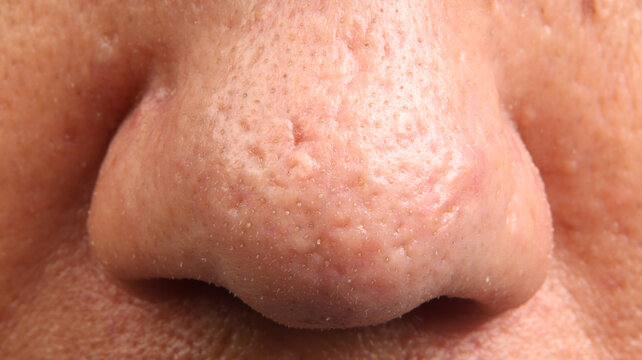 Close up macro view of a human nose showing skin problems. Enlarged pores and whiteheads