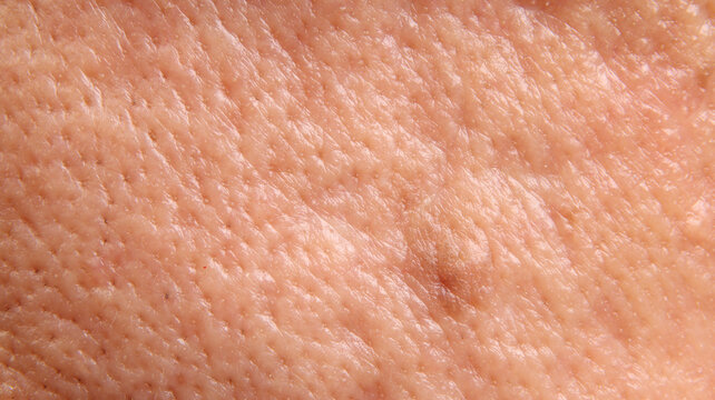 Macro closeup of human skin showing a raised mole or skin with visible pores uneven texture