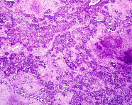 Parotid gland. Pleomorphic adenoma