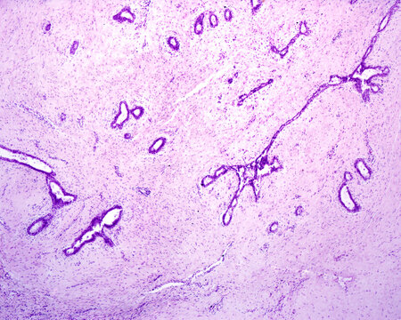 Breast fibroadenoma