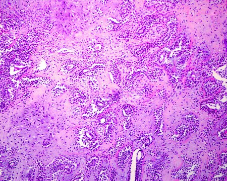 Parotid gland. Pleomorphic adenoma