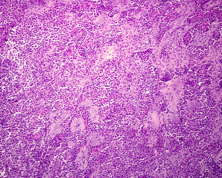 Parotid gland. Pleomorphic adenoma
