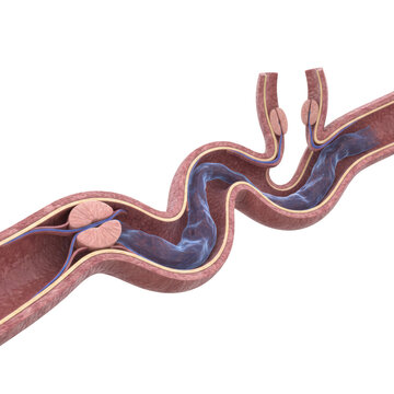 Detailed 3d cross section of a varicose human vein with damaged valves and pooling blood against a white clinical background medical pathology concept