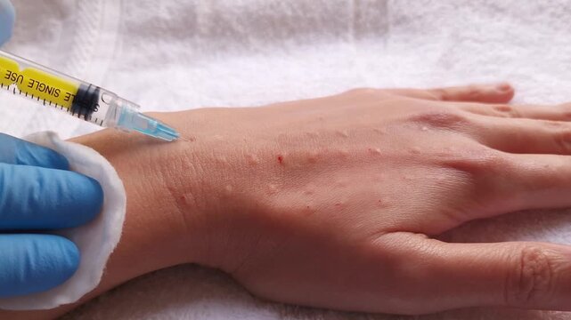 A close-up shot of a dermatologist in blue gloves performing a biorevitalization injection on a patient's hand using a syringe with yellow liquid in a bright clinical setting.