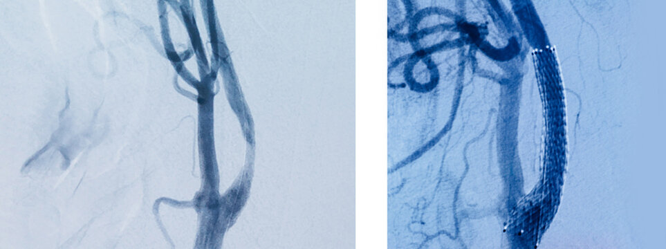 Angiographic images showing arterial stenosis and stent placement comparison for vascular intervention and endovascular treatment