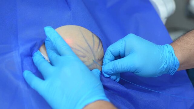 Professional medical footage showing a surgeon performing laser-assisted liposuction. Detailed view of the laser fiber being inserted into the subcutaneous tissue of a patient, featuring blue surgical