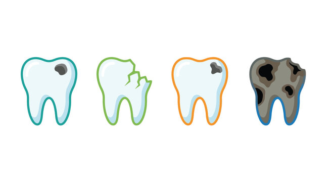 Stages of tooth decay illustrated with progressively worsening dental health