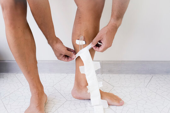 Male legs, thighs and groin in bandages along the saphenous vein and compression white underwear and tights being examined by a surgeon in a hospital after surgery rehabilitation