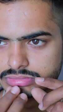 Close up of a man showing a painful mouth ulcer on his lower lip