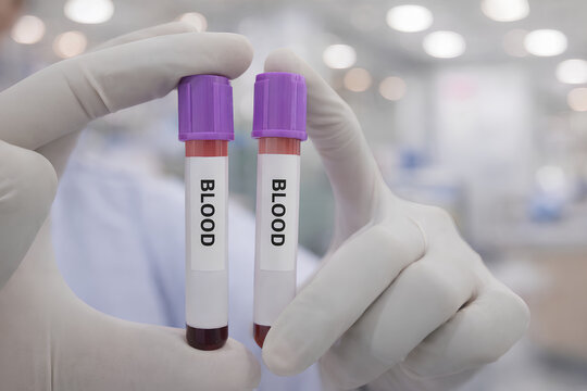 Blood Sample Tube in Hand with Blurred Laboratory Background, EDTA, antikoagulan, purple, vacum sample tube, hematology, specimen. Concept of medical testing, healthcare, laboratory analysis