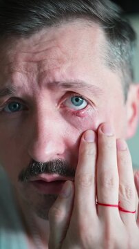 A man is looking closely at his eye while showing signs of discomfort due to chalazion inflammation. He studies the area around his eye while gently touching it, focusing on the inflammation and pus