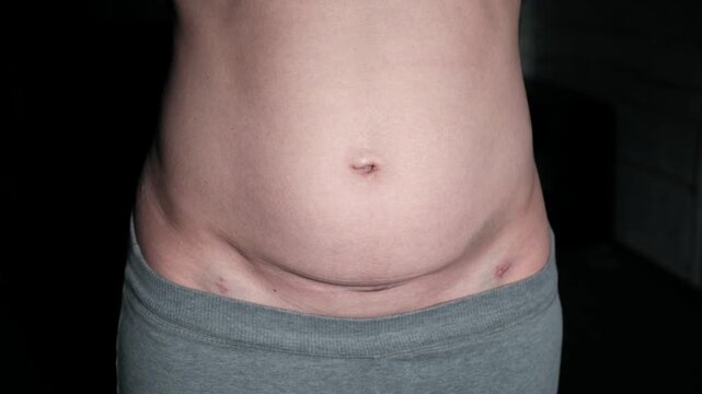 Fresh medical scars on female abdomen after laparoscopic surgery. Stretch marks on light caucasian skin after cesarean section on dark background. Body Lymphatic edema. Maternity concept. Front view.