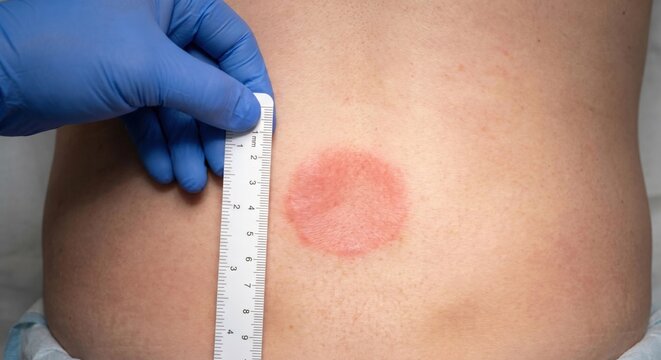 Healthcare professional measuring pressure sore on patient