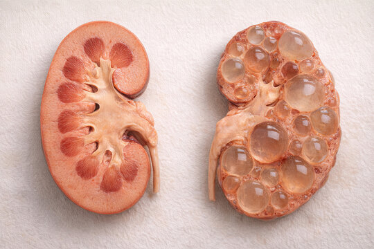 Normal Kidney vs Polycystic Kidney Disease Cross Section