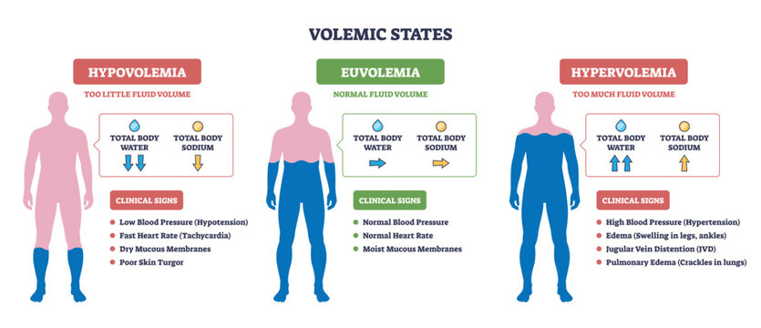 Volemic States brief diagram contrasts body fluid balance, human silhouettes, arrows, and labeled panels show hypovolemia, euvolemia, hypervolemia concepts. Outline diagram