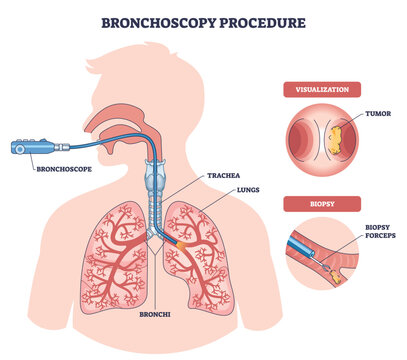 Bronchoscopy procedure illustrated, airflow pathway and tumor biopsy shown as a scope passes through trachea into lungs, key elements are bronchoscope, bronchi, biopsy forceps. Outline diagram