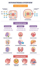 Hyponatremia overview shows cell swelling as water enters with low sodium, icons summarize causes and symptoms. Key objects, cell, sodium ions, water drops. Outline diagram