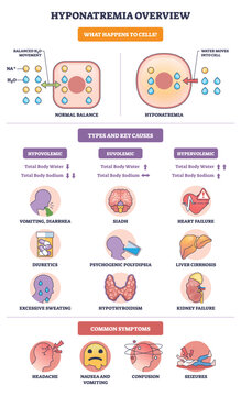 Hyponatremia overview shows cell swelling as water enters with low sodium, icons summarize causes and symptoms. Key objects, cell, sodium ions, water drops. Outline diagram