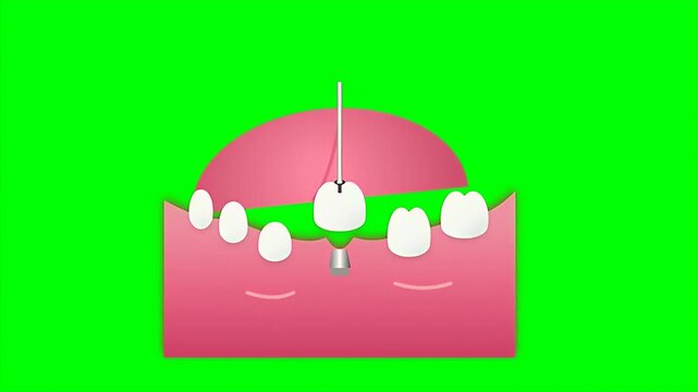Animated medical illustration showing a dental implant crown being placed onto an abutment in the gums