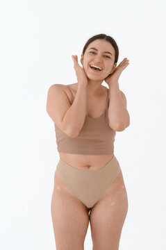 Smiling woman in beige lingerie with vitiligo  