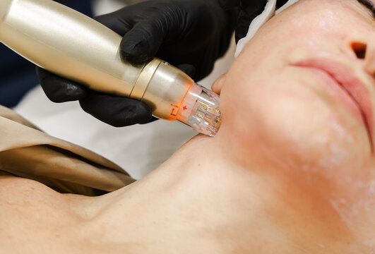  Macro RF Microneedling on Neck Skin