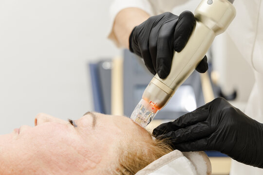 RF Treatment on Forehead with Equipment in Background
